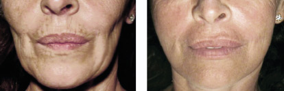 destrutturazioni_ipovolumetriche