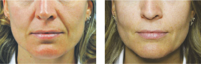 ipovolumetrie_localizzate