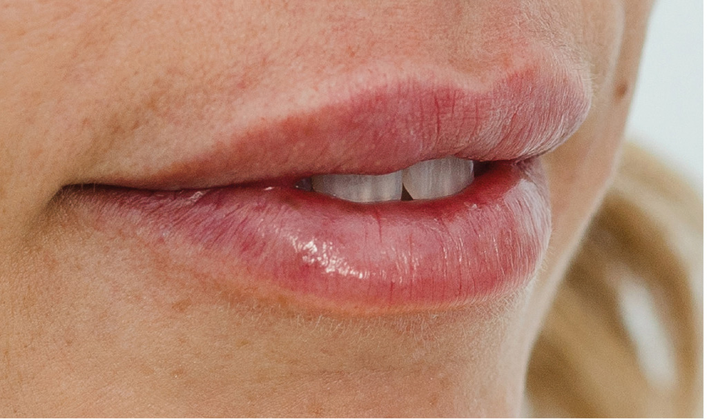 Regenyal Idea Lips - Biorivolumetria