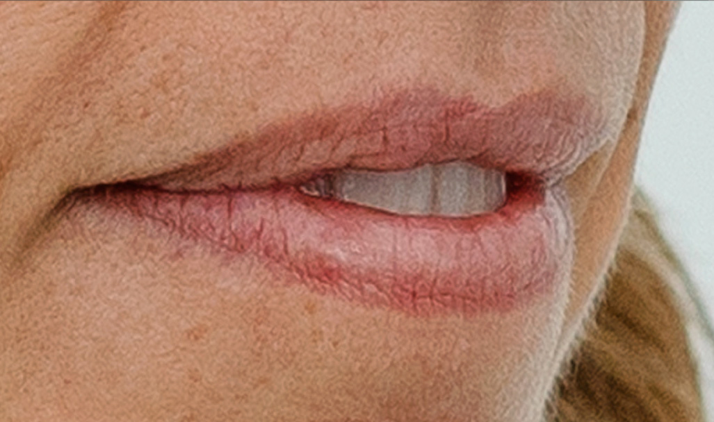 Regenyal Idea Lips - Biorivolumetria